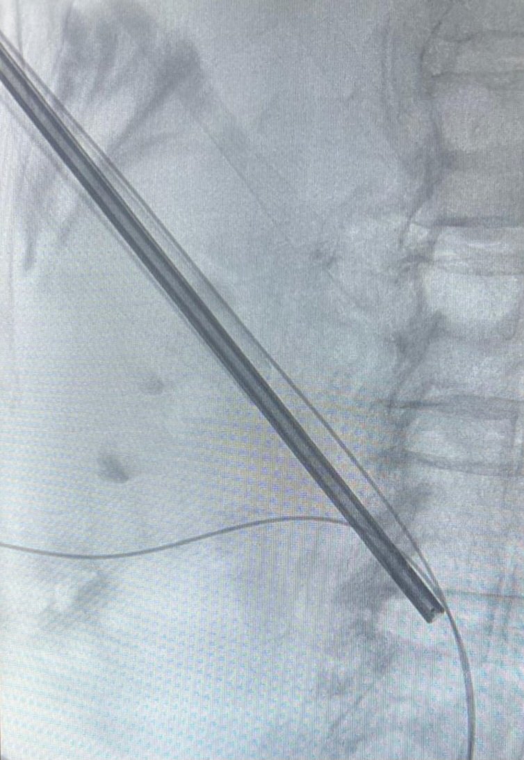 Marcos Cepeda (@drmarcoscepeda) on Twitter photo Advanced supine #PCNL workshop at #HURH with <a href="/CoralManso/">Coral Manso Aparicio</a>
US & fluoroscopy
Complex cases
#miniECIRS
#uppercalyx
Thanks to <a href="/bsc_urology/">Boston Scientific Urology</a> for the support
#lithovueElite
Proud of my team!
<a href="/kikegonzalez11/">Enrique G. MD</a> <a href="/PaulaMaple/">Paula Arce</a> Advanced supine #PCNL workshop at #HURH with <a href="/CoralManso/">Coral Manso Aparicio</a>
US & fluoroscopy
Complex cases
#miniECIRS
#uppercalyx
Thanks to <a href="/bsc_urology/">Boston Scientific Urology</a> for the support
#lithovueElite
Proud of my team!
<a href="/kikegonzalez11/">Enrique G. MD</a> <a href="/PaulaMaple/">Paula Arce</a>