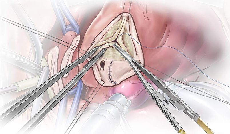 Root reduction and tricuspidization makes every truncal valve in neonates repairable. For detail read: Konstantinov IE. Truncal valve repair in neonates. J Thorac Cardiovasc Surg 2025;170:17-22. pubmed.ncbi.nlm.nih.gov/39706548/