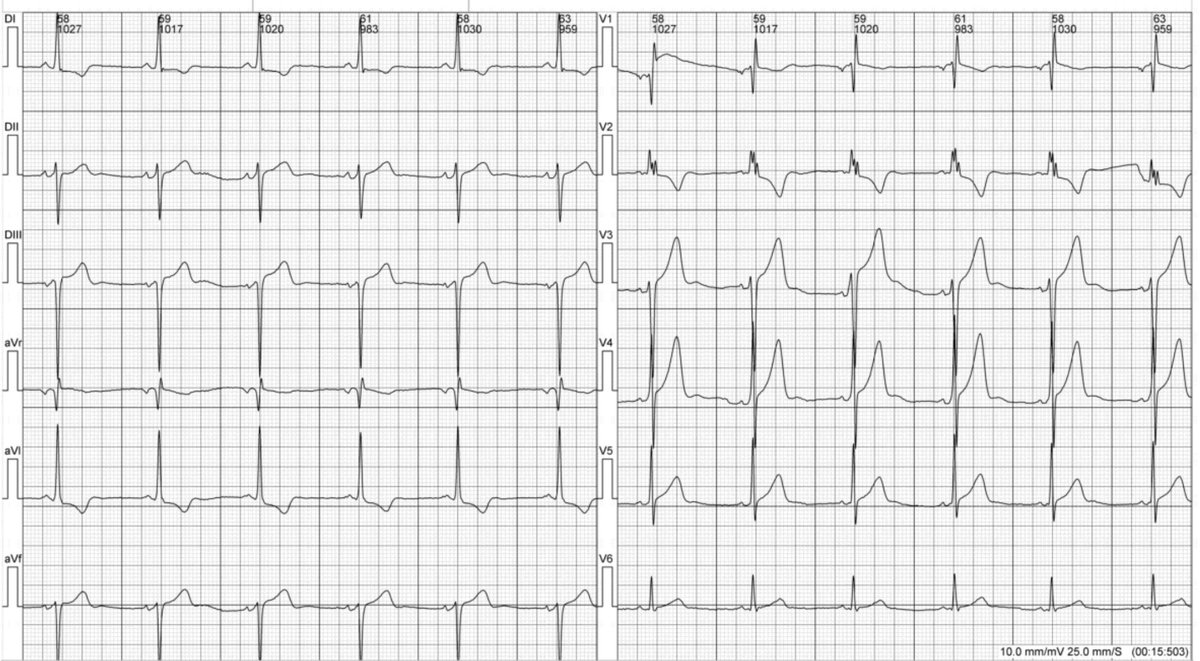 Paciente de 20 años con hipertrofia septal severa en ecocardiograma y este electrocardiograma. Algo que les llame la atención?