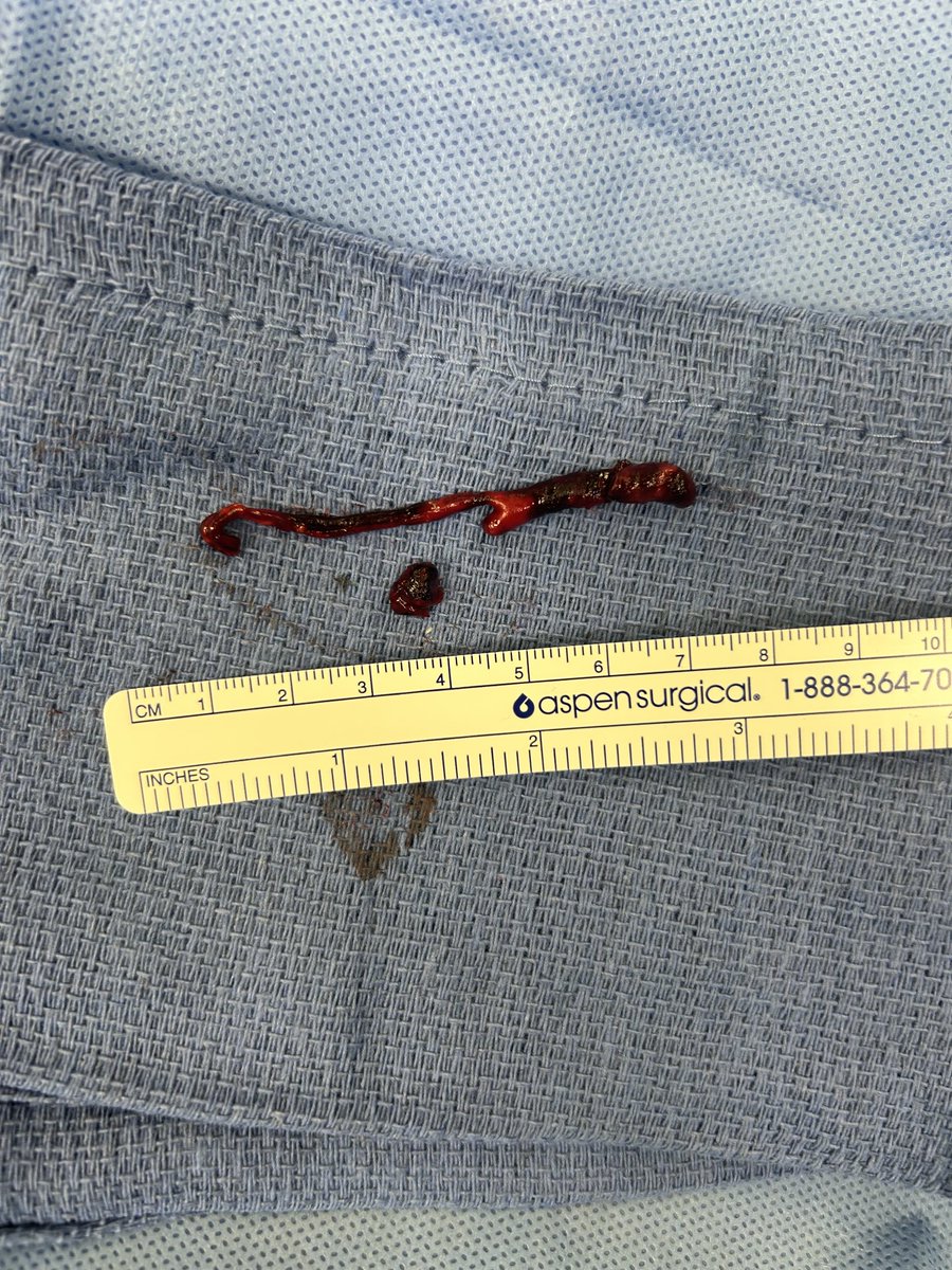 cfbechara (@cfbechara) on Twitter photo Mark the brachial bifurcation, expose it at its bifurcation and you can pull all this clot under local/mac. Happy hand and fingers instantly. And Kids stay away from drugs! It never ends well 😢 Mark the brachial bifurcation, expose it at its bifurcation and you can pull all this clot under local/mac. Happy hand and fingers instantly. And Kids stay away from drugs! It never ends well 😢