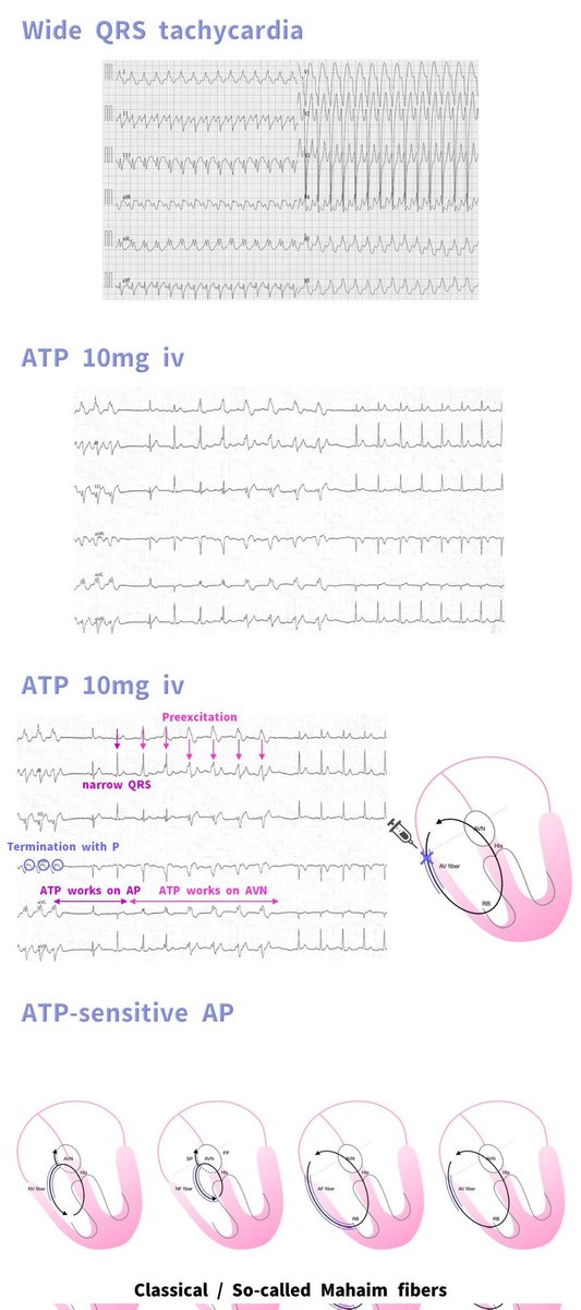 Milan Koštek (@kostekmilan) on Twitter photo Click the pic to reveal the connection between embryology and arrhythmias.
<a href="/Koichi16423232/">Koichi Nagashima@EP Univ. Ablation School</a> has shown Mahaim fibers properties and their response to adenosine which is similar to AV node just like their origin. Click the pic to reveal the connection between embryology and arrhythmias.
<a href="/Koichi16423232/">Koichi Nagashima@EP Univ. Ablation School</a> has shown Mahaim fibers properties and their response to adenosine which is similar to AV node just like their origin.