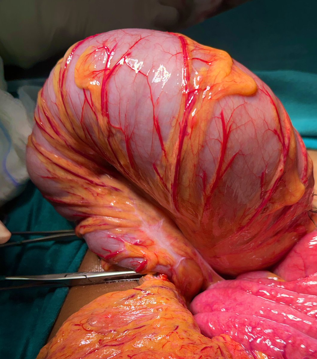 Here is a super-distended sigmoid colon almost about to perforate (burst open) due to a closed loop obstruction caused by a lumen obstructing rectal cancer in a 28 year old lady. 

Timely intervention saved her from a life threatening emergency. 

<a href="/BalcoMedical/">BALCO Medical Centre</a>