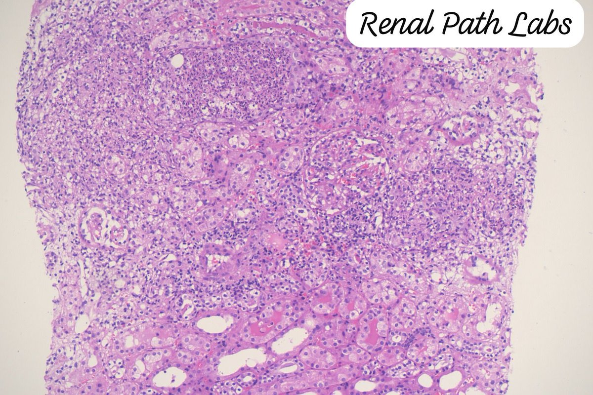 RenalPathLabs's tweet image. Rare to see Fungal pyelonephritis in graft,that too Candida species & inciting granulomatous reaction,no fever..🤞🏻
Few things are just strange in Renal Pathology.
#RenalPathology #TxBiopsy #RareRenalCase #NephTwitter #PathTwitter #RenalPathLabsGurugram
@Renalpathsoc #AskRenal