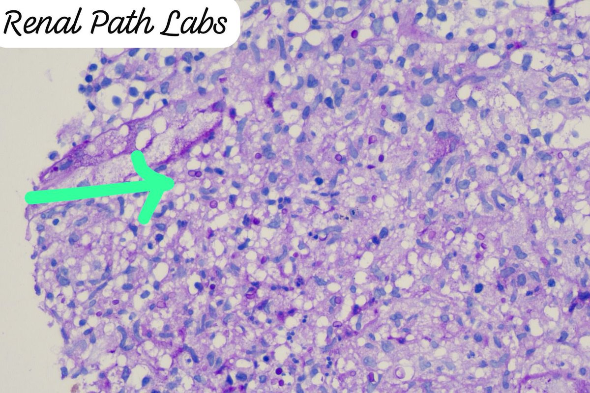 RenalPathLabs's tweet image. Rare to see Fungal pyelonephritis in graft,that too Candida species & inciting granulomatous reaction,no fever..🤞🏻
Few things are just strange in Renal Pathology.
#RenalPathology #TxBiopsy #RareRenalCase #NephTwitter #PathTwitter #RenalPathLabsGurugram
@Renalpathsoc #AskRenal