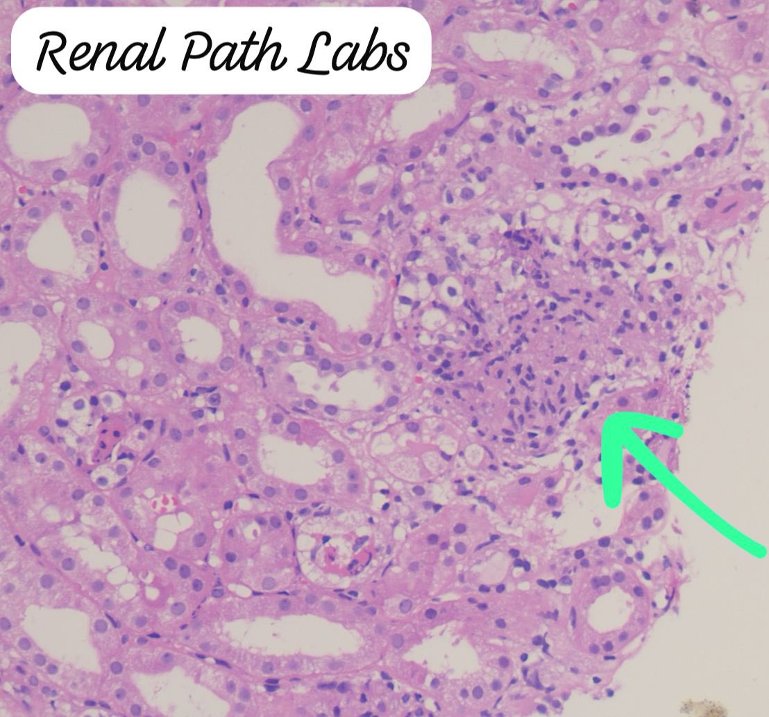 RenalPathLabs's tweet image. Rare to see Fungal pyelonephritis in graft,that too Candida species & inciting granulomatous reaction,no fever..🤞🏻
Few things are just strange in Renal Pathology.
#RenalPathology #TxBiopsy #RareRenalCase #NephTwitter #PathTwitter #RenalPathLabsGurugram
@Renalpathsoc #AskRenal