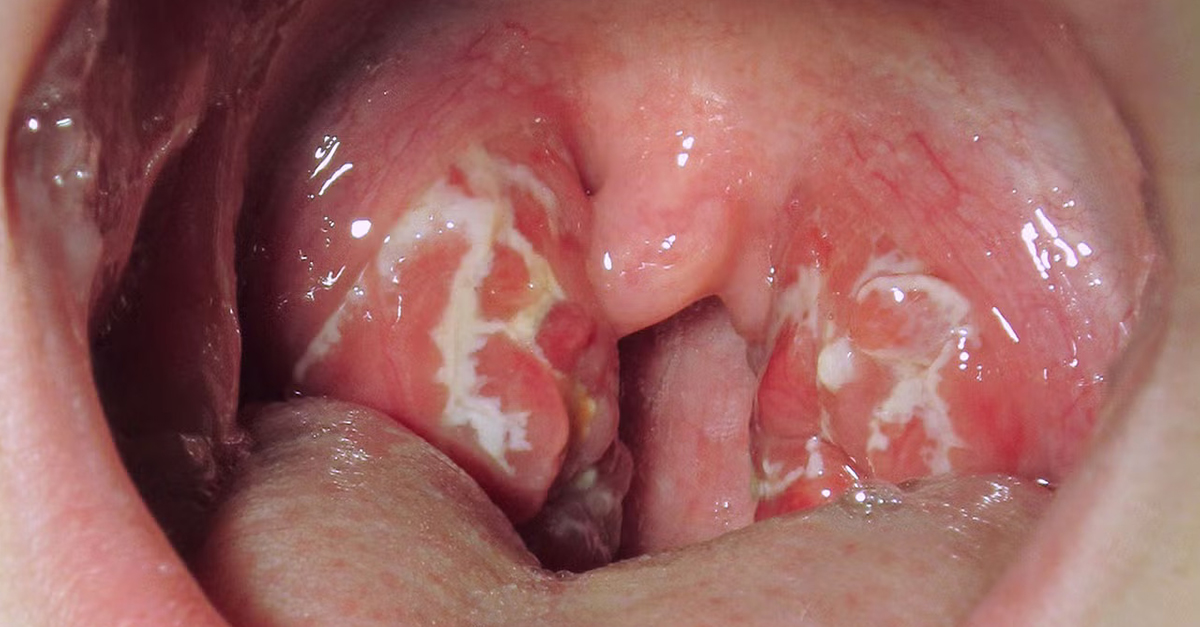 #QUIZ: Angine streptococcique : antibiotiques ou pas ? #MedTwitter
ms.spr.ly/6016SvULr