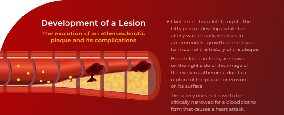 International Atherosclerosis Society (IAS) (@atherosociety) on Twitter photo Atherosclerotic plaques develop in large- and medium-sized arteries in places with disturbed blood flow, such as branch points or curves.
Read more in IAS' white paper, "Assessment & Treatment of Inflammation in Atherosclerosis:" bit.ly/4fh2Hbl Atherosclerotic plaques develop in large- and medium-sized arteries in places with disturbed blood flow, such as branch points or curves.
Read more in IAS' white paper, "Assessment & Treatment of Inflammation in Atherosclerosis:" bit.ly/4fh2Hbl