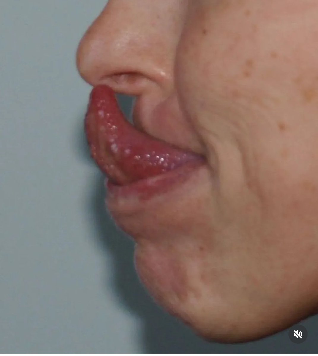 Gorlin Sign, the ability to touch the tip of the nose with the tip of the tongue. It's associated &amp; may be a diagnostic sign for Ehlers-Danlos syndrone (EDS) indicating hypermobolity of the temporo-mandibular joint (TMJ) &amp; absence of the lingual frenulum in some patients with EDS