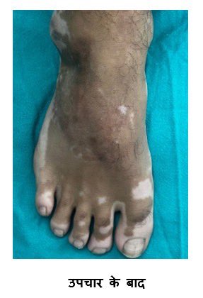 एम्स जोधपुर में विटिलिगो दिवस पर जन व्याख्यान

सफेद दाग (Vitiligo) से जुड़ी भ्रांतियों को दूर करें, इलाज, मानसिक स्वास्थ्य और सहयोग की अहमियत पर जानें।

🗓 25 जून 2025 | 🕝 2:30 PM – 4:00 PM
📍 लेक्चर थिएटर-1, कॉलेज बिल्डिंग, एम्स जोधपुर

हम सभी नागरिकों से आग्रह करते हैं, आइए,