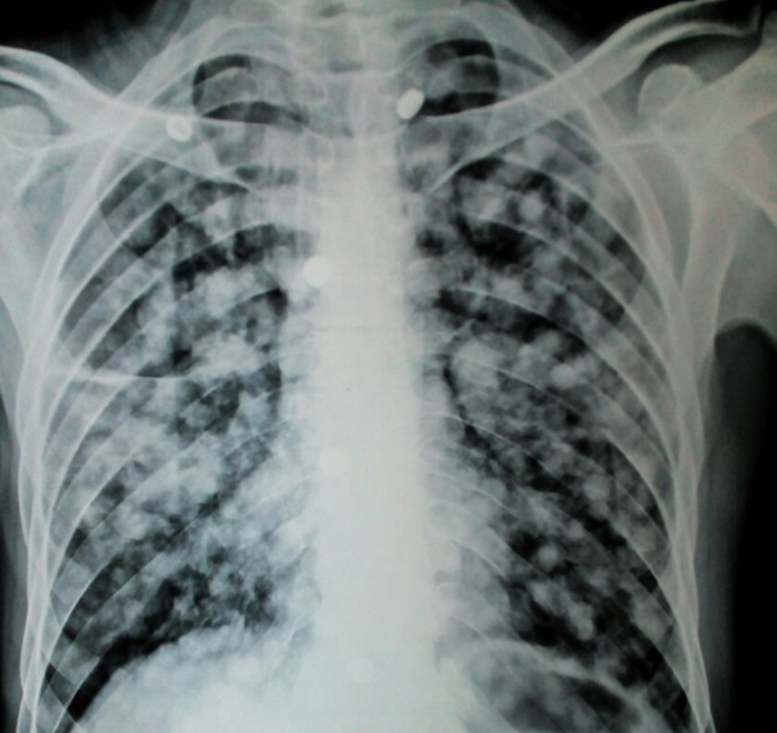 A 72-year-old man presented with weight loss, decreased appetite, and iron deficiency anaemia. Chest X-ray was done and given below. What is the likely diagnosis?

Image CC: Chainaram Internal Medicine