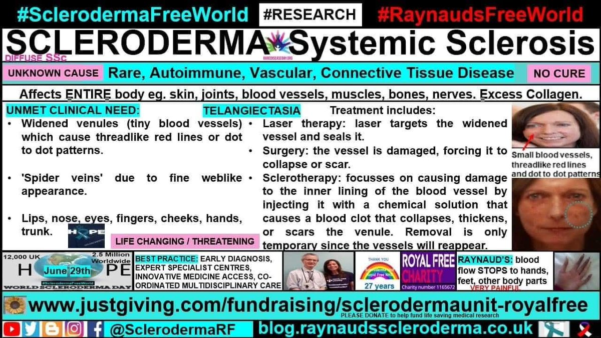 cosmicfairy444's tweet image. #SclerodermaAwarenessMonth TELANGIECTASIA Infographic Symptoms, Treatment Options. 
blog.raynaudsscleroderma.co.uk/2018/05/telang…
#SclerodermaFreeWorld #RaynaudsFreeWorld #Research #Scleroderma #SystemicSclerosis #Raynauds #Autoimmune #RareDisease #NoCure #UnknownCause #LifeChanging #ConnectiveTissue