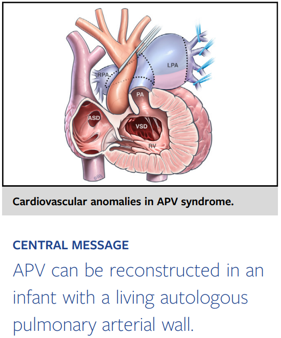 Absent pulmonary valve syndrome: Valvular reconstruction with autologo... sciencedirect.com/science/articl…