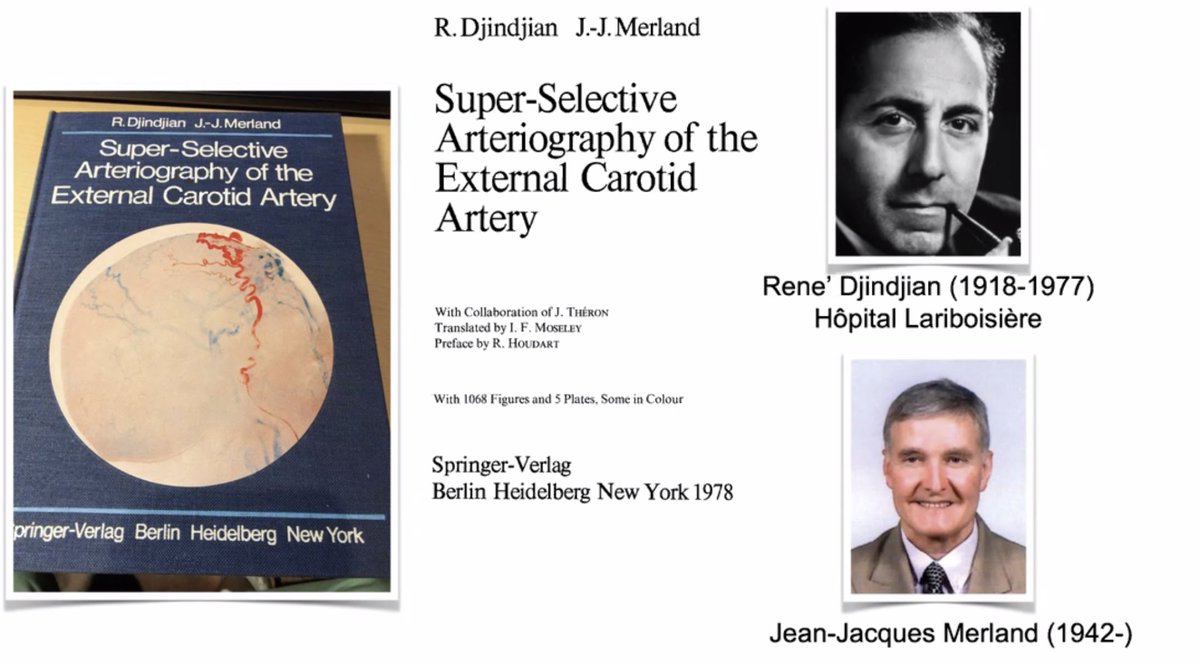 S_Pesch's tweet image. Did you know that the classification by Djindjian and Merland, published in 1978, was the first #systematic attempt to categorize #DAVFs based on venous drainage patterns? Its main contribution was the pioneering recognition that the clinical risk of a DAVF — particularly the…
