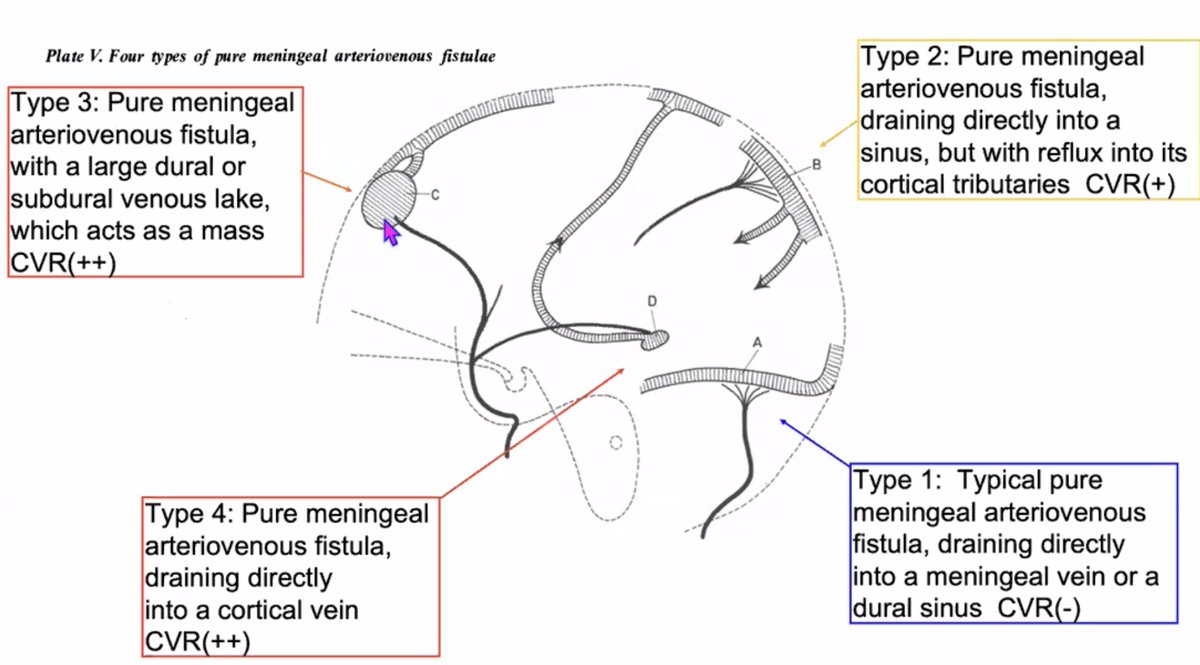 S_Pesch's tweet image. Did you know that the classification by Djindjian and Merland, published in 1978, was the first #systematic attempt to categorize #DAVFs based on venous drainage patterns? Its main contribution was the pioneering recognition that the clinical risk of a DAVF — particularly the…