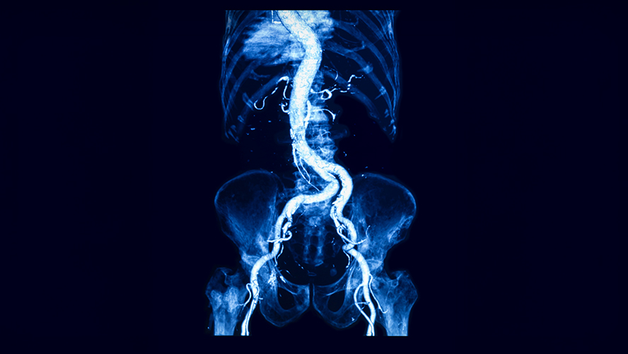 UHN Research (@uhn_research) on Twitter photo Abdominal aortic aneurysms are silent killers and a leading cause of death in men over 65.
New research from <a href="/UHN/">University Health Network</a>’s <a href="/TGHRI_UHN/">Toronto General Hospital Research Institute</a> uncovers how smoking damages the aorta and activates immune cells that drive rupture, paving the way for new treatments.
🔗 : uhnresearch.ca/news/understan… Abdominal aortic aneurysms are silent killers and a leading cause of death in men over 65.
New research from <a href="/UHN/">University Health Network</a>’s <a href="/TGHRI_UHN/">Toronto General Hospital Research Institute</a> uncovers how smoking damages the aorta and activates immune cells that drive rupture, paving the way for new treatments.
🔗 : uhnresearch.ca/news/understan…