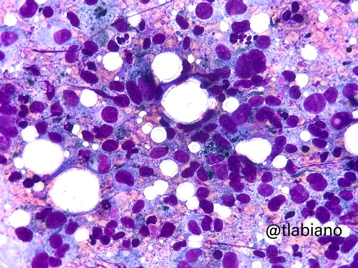 tlabiano's tweet photo. 🔬💉Lymph node #FNA - malignant melanoma cells with enlarged nuclei, binucleation, and black pigment.
Summer is here☀️It’s time to enjoy and protect yourself and your loved ones⚠️ 🧴⛱️🕶️
#cytopath #cytology https://t.co/K3JHHP6473
