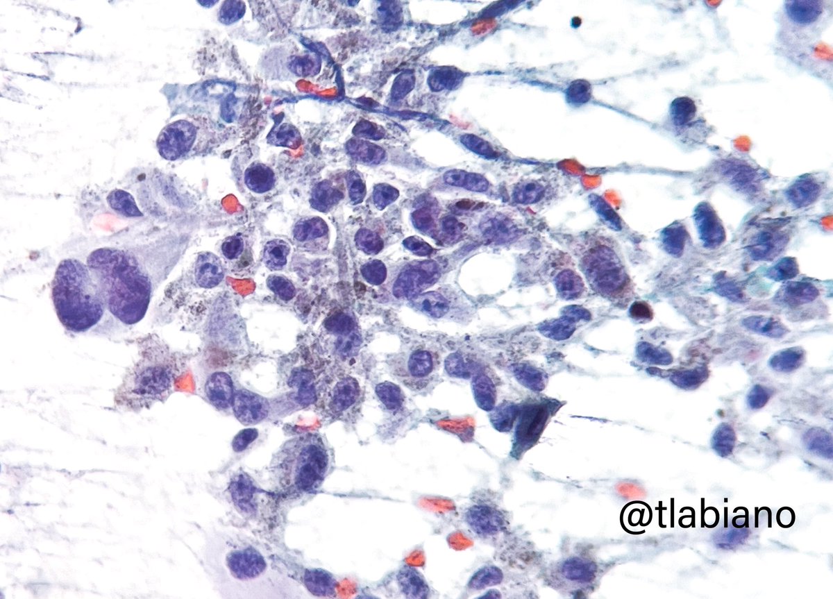 tlabiano's tweet photo. 🔬💉Lymph node #FNA - malignant melanoma cells with enlarged nuclei, binucleation, and black pigment.
Summer is here☀️It’s time to enjoy and protect yourself and your loved ones⚠️ 🧴⛱️🕶️
#cytopath #cytology https://t.co/K3JHHP6473
