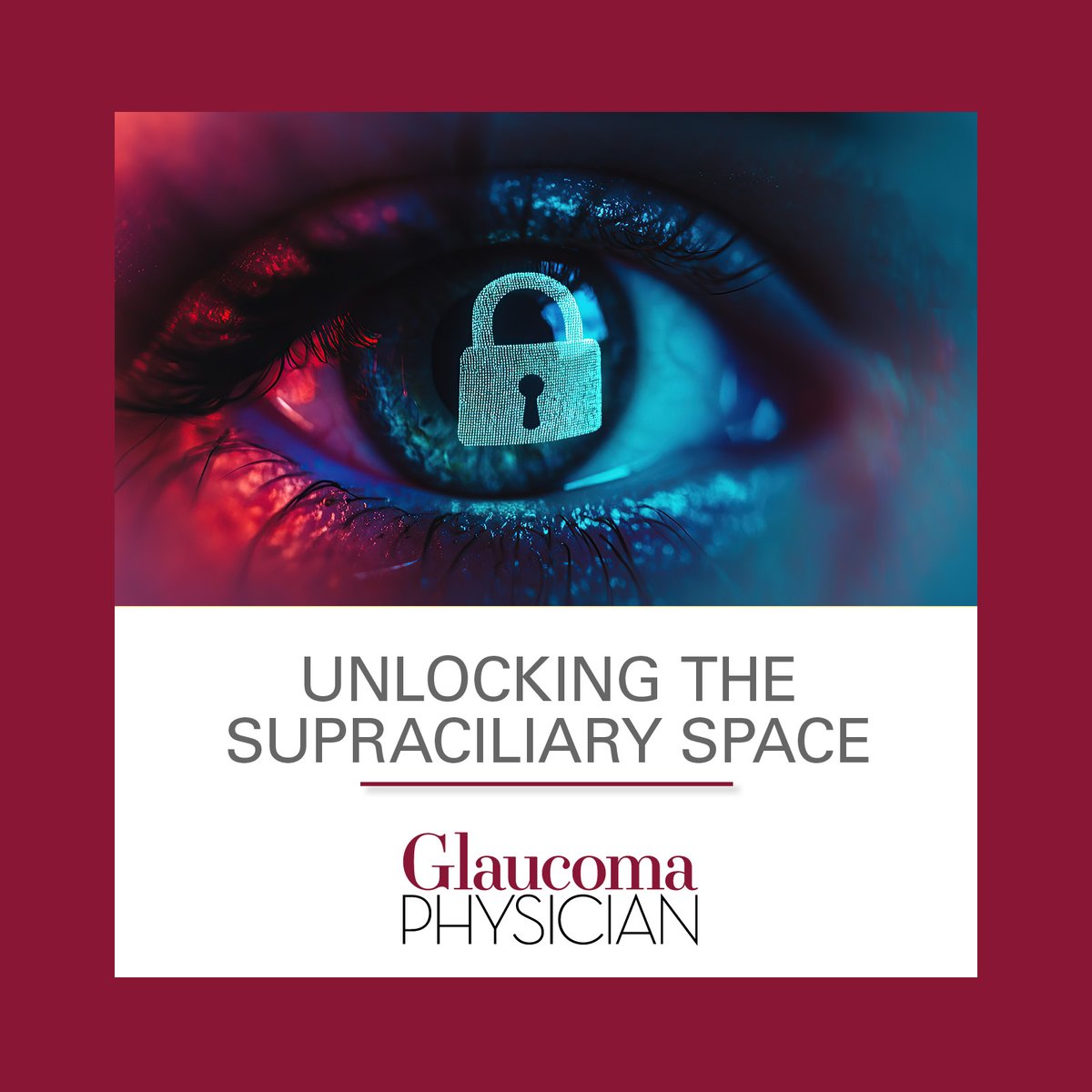Arsham Sheybani, MD, and Tugce Turer discuss how targeting uveoscleral outflow may result in greater IOP reduction with fewer complications. Read more: ow.ly/yUwE50W6yxy
#GlaucomaPhysician #GPnews #Iantrek #iStarMedical #Conexiant