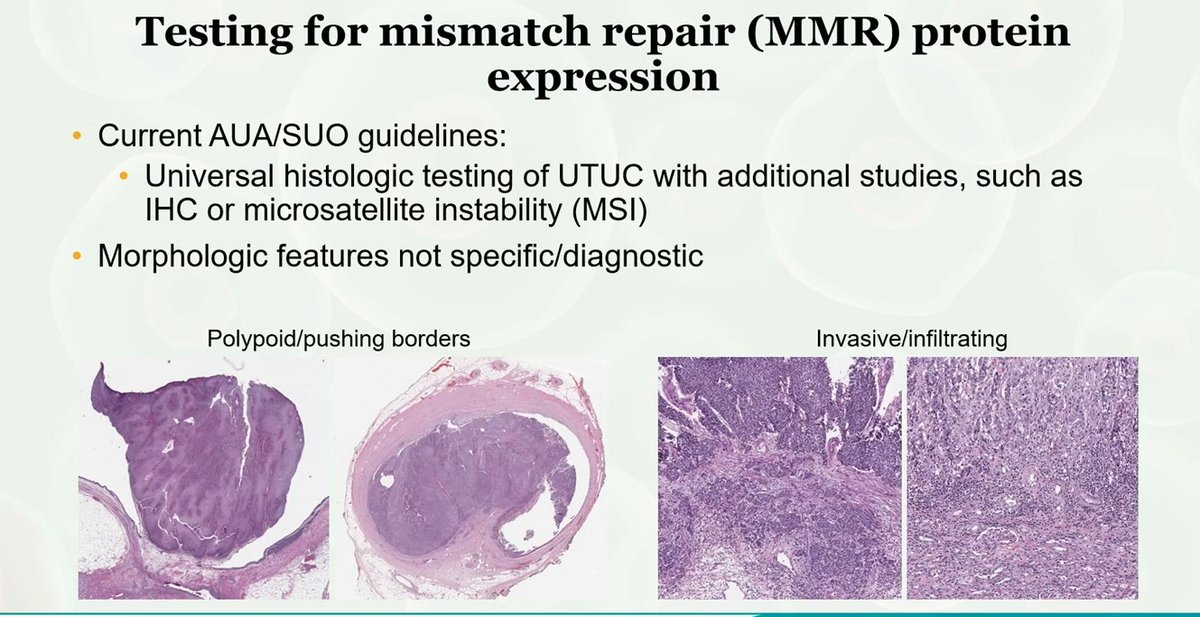 Urothelial carcinoma and MMR testing:
-Urothelial carcinoma is the 3rd most common cancer in Lynch Syndrome patients
-Preferentially develops in upper urinary tract

Dr. Al-Ahmadie #USCAP25 #pathology #PathX