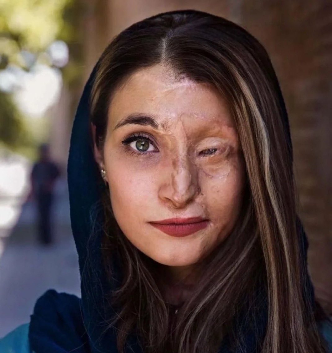 DrEliDavid's tweet image. This is Marzieh Ebrahimi. Acid was thrown on her face for the crime of not wearing hijab (head covering).

This is the true face of the Islamic Republic.