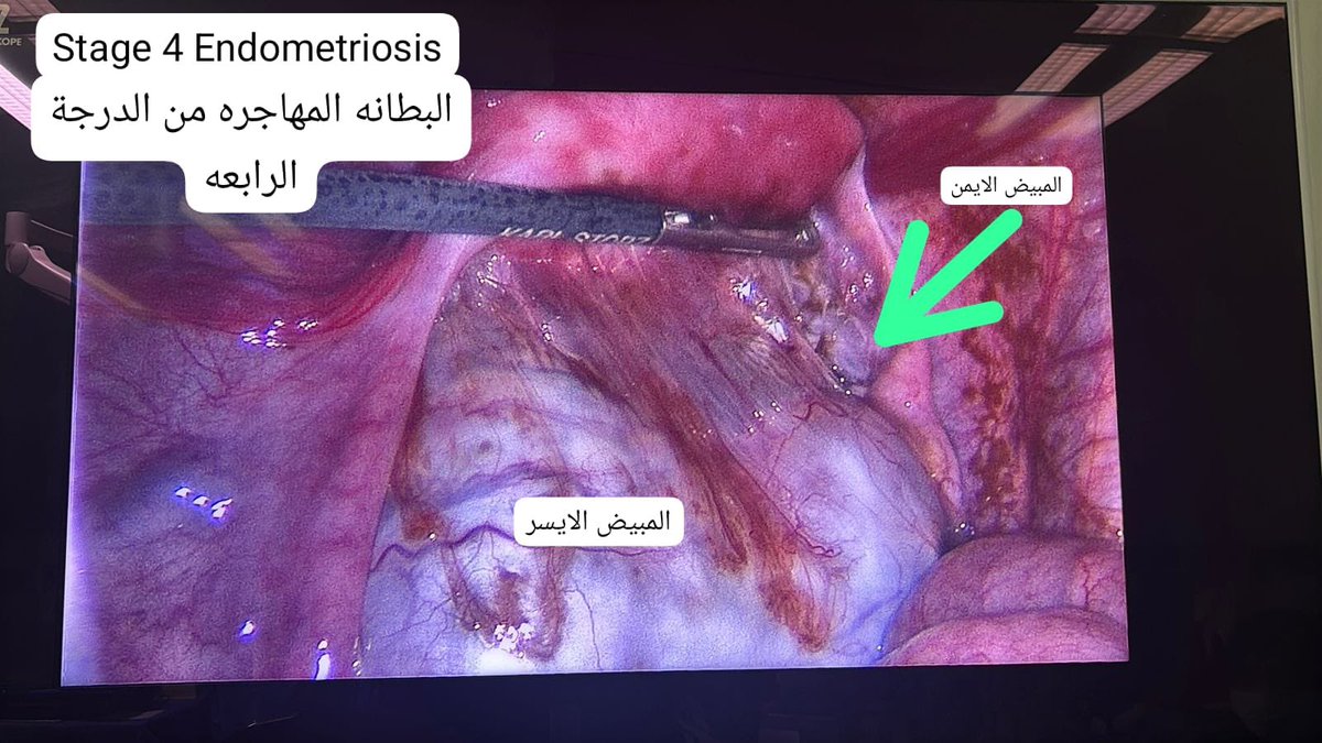جراحة البطانة المهاجره 
Endometriosis
