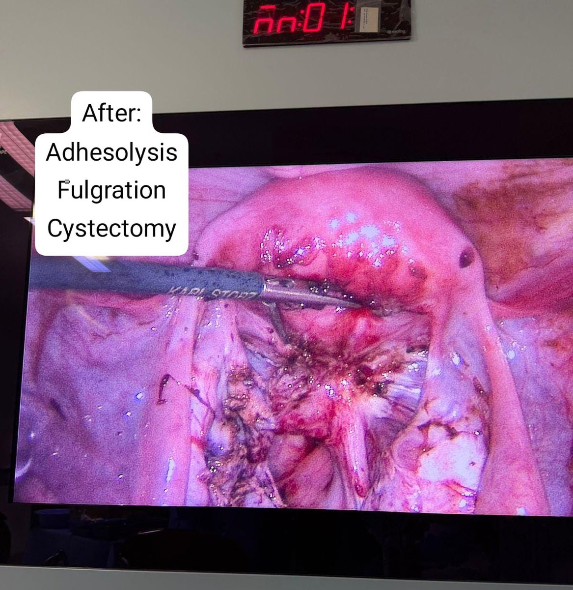 DRmegren's tweet photo. جراحة البطانة المهاجره 
Endometriosis https://t.co/xdOUR6I2X5