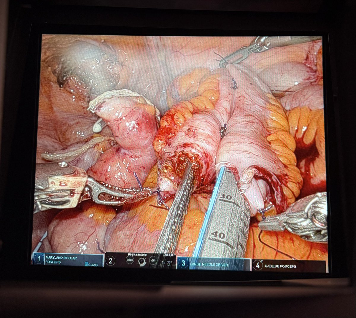 Robotic bilateral ileal ureter with ileal cystoplasty