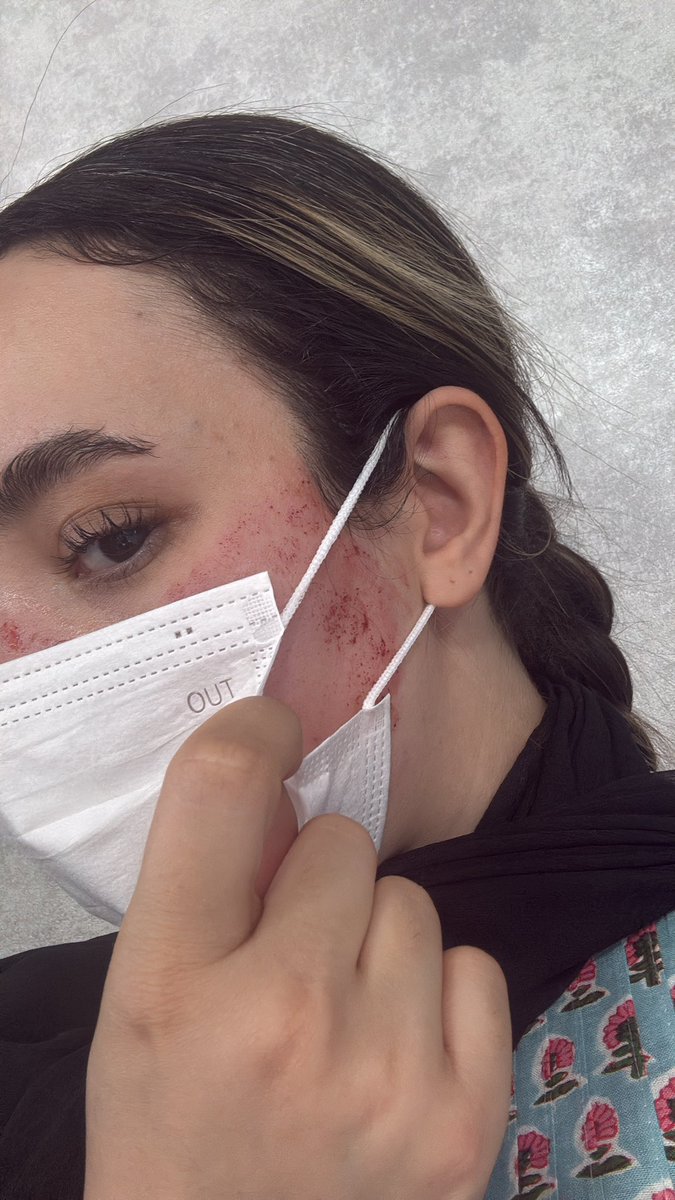 انقدر روتین پوستیمو سفت و سخت رعایت میکنم که حتی وسط این اوضاع رفتم میکرونیدلینگ کردم برای شفافیت بیشتر پوستم:))