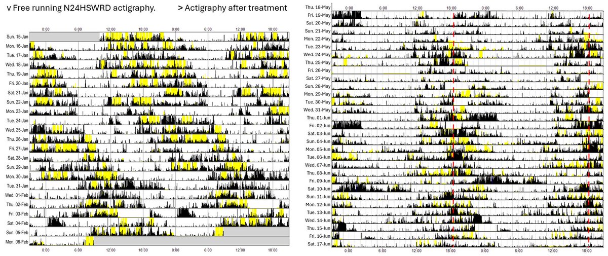 PracticalNeurol's tweet image. Non-24h SWRD may present hypersomnia with a distinctive actigraphy. Treat with sleep-light rescheduling, melatonin and (we recommend) motivational interviewing