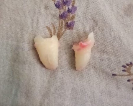 Wasn’t scared of the wisdom tooth extraction, was scared of entering my villain arc post-op 😵‍💫. Pratty’s officially cooked, send soup.
Shoutout to <a href="/caffeinepyaar/">nishant</a> for surviving my hyper non-chalant era.
P.S. don't get any teeth thingy done if you're not at home, you need Maa istg.