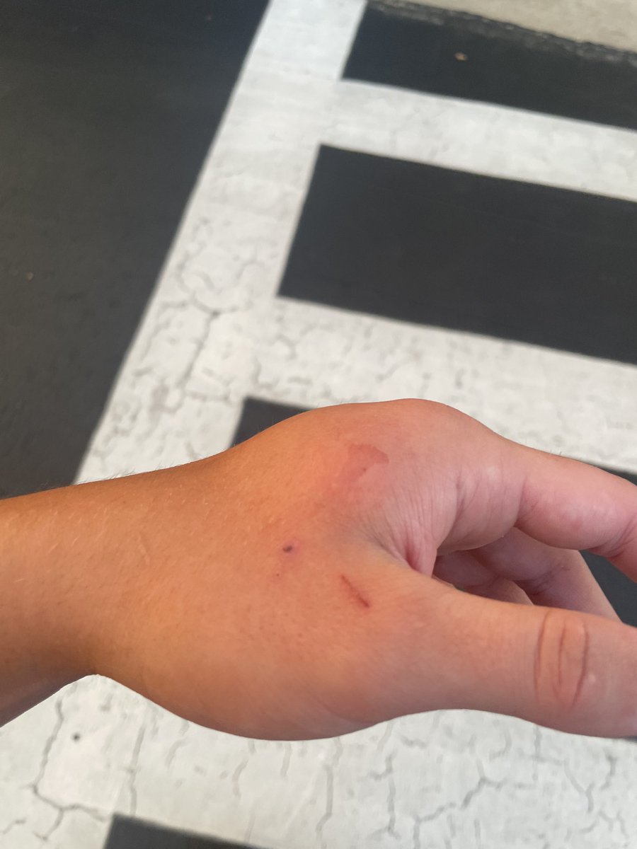 I was having a great day competing at Top Gun this last Friday until I broke my hand at the end of the day.  The ER recommended that I see an orthopedic ASAP back home.  Leaving the Dr. now with a cast.  Unfortunately, this may end my camp season to ensure that I am ready to go