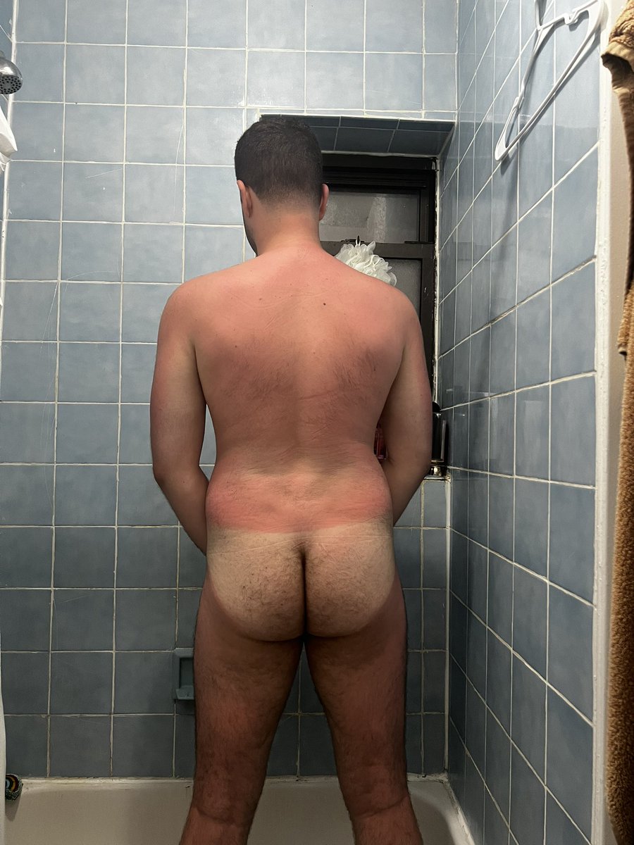 Got so sunburnt I feel like a cherry 😭🍒