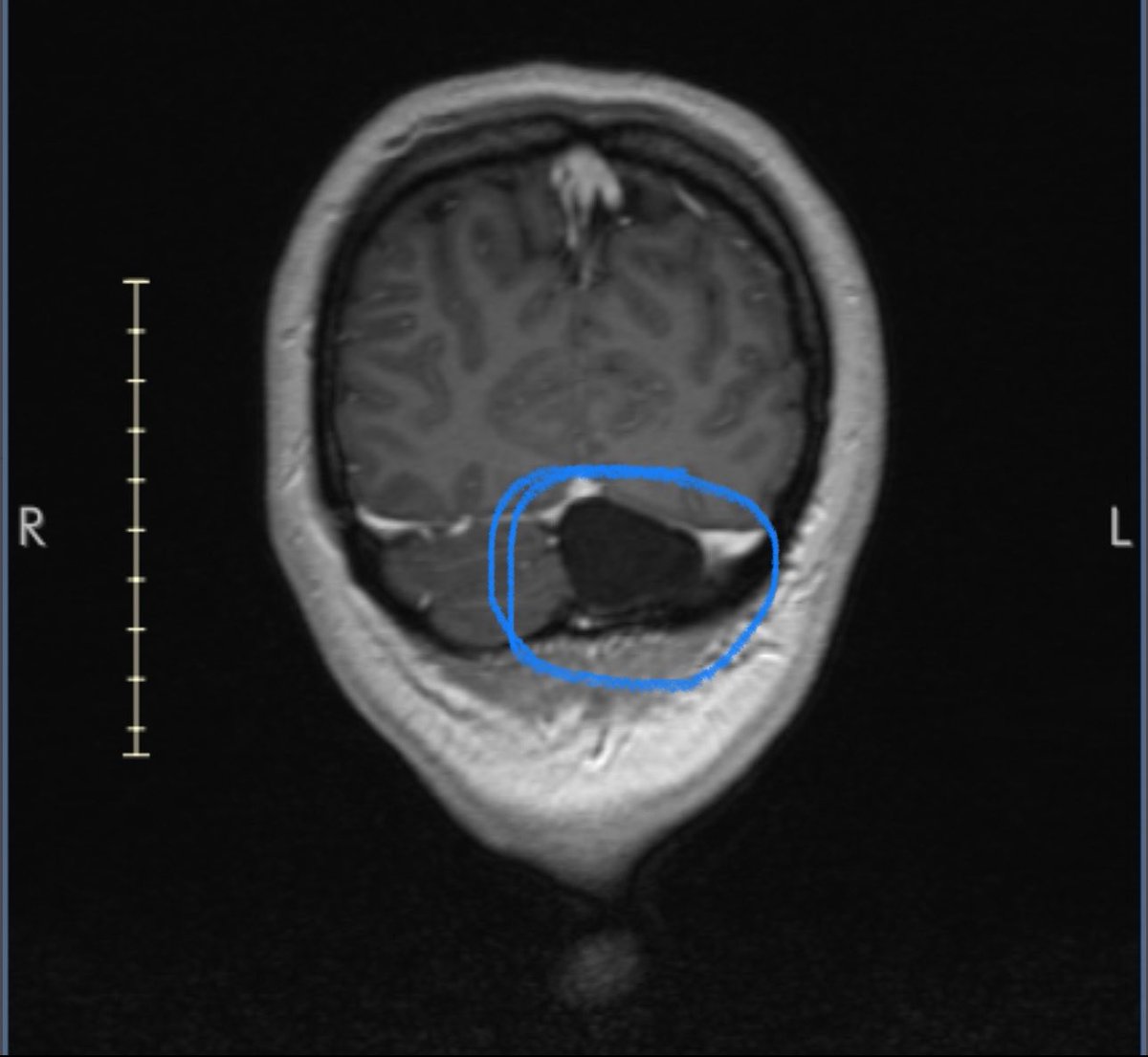 ‼️ Warning: MRI brain scan / brain cyst ‼️

GUYS LOOK ITS BLUBBI!!! 
Say hi 🥹 I grew Blubbi myself uwu 

I have an appointment coming up soon to go over my MRI images and then I’ll be seeing a neurologist!