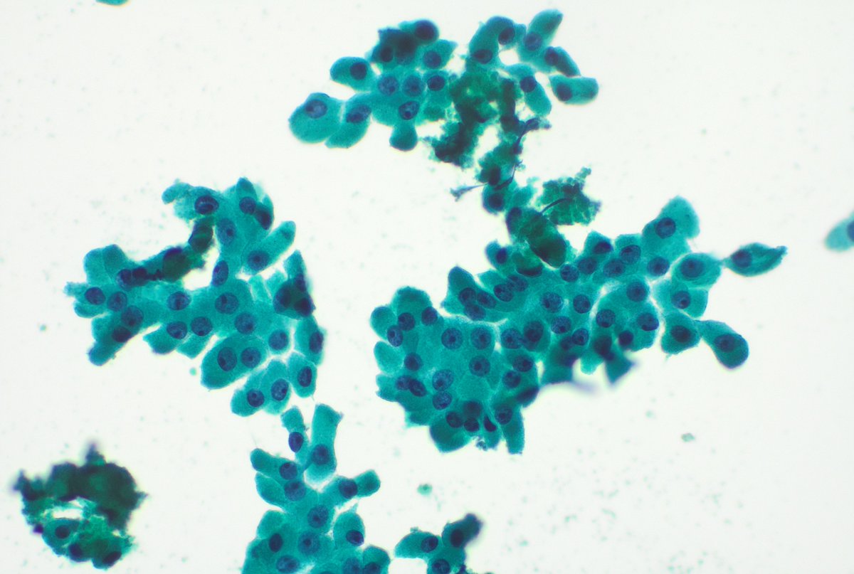 The beautiful case of today.  Oncocytic cells in thyroid cytology😇🥰 <a href="/tlabiano/">Tania Labiano</a> <a href="/citologiala/">citologiala</a> <a href="/Dra_Cells/">Caddie Laberiano-Fernández, MD, FIAC</a> <a href="/MerceJorda1/">Merce Jorda</a> <a href="/andreagersz/">Andrea Gersztein</a> <a href="/IPena19485/">Isabel Peña</a>
