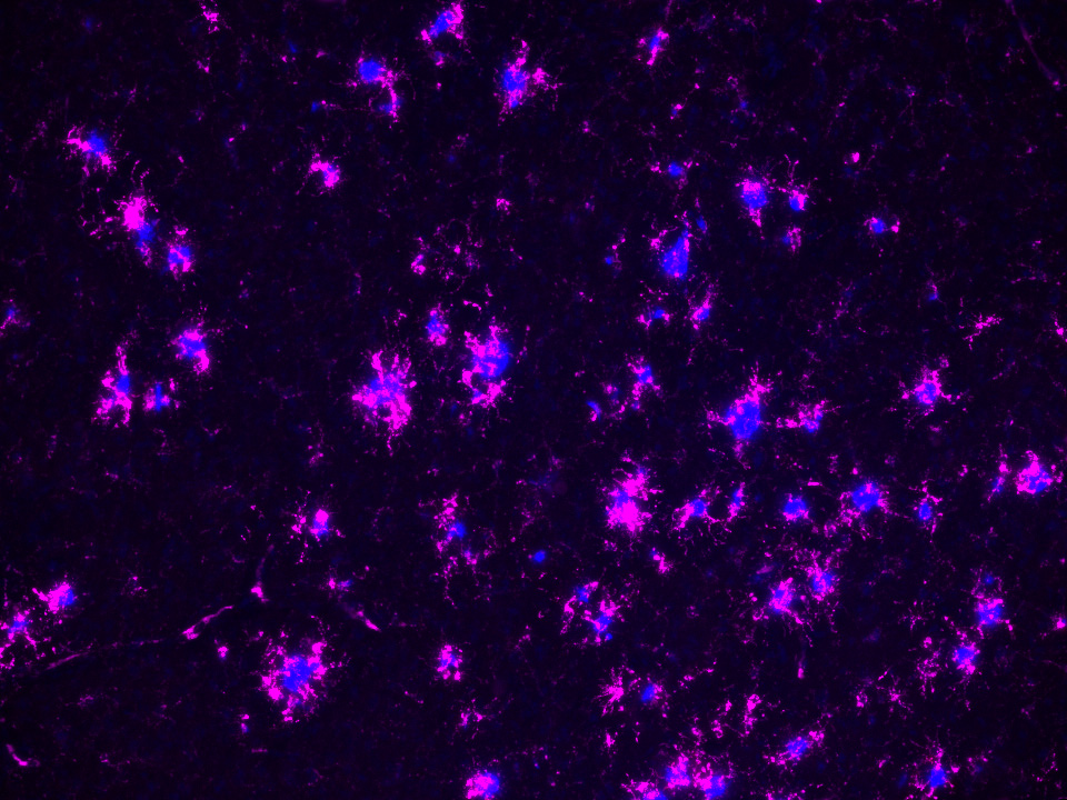 FlyBottleEscape's tweet image. im also an alzheimer's researcher now too ... 😜
angry CD68+ microglia eating some X-34 dyed plaques