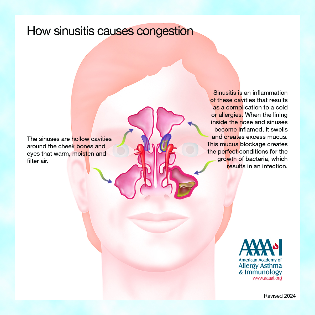 If your stuffy nose and cough last longer than 10-14 days or worsens after 7-10 days, you may have more than a cold. Rhinosinusitis, also known as sinusitis, is a swelling of one or more of your nasal sinuses and nasal passages. #allergy #sinusitis
aaaai.org/tools-for-the-…