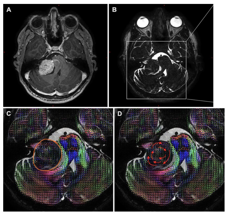 #OnlineFirst: Fiber orientation distribution for detecting skull base tumor histopathology: technical note and retrospective 81-case series. 

thejns.org/view/journals/…