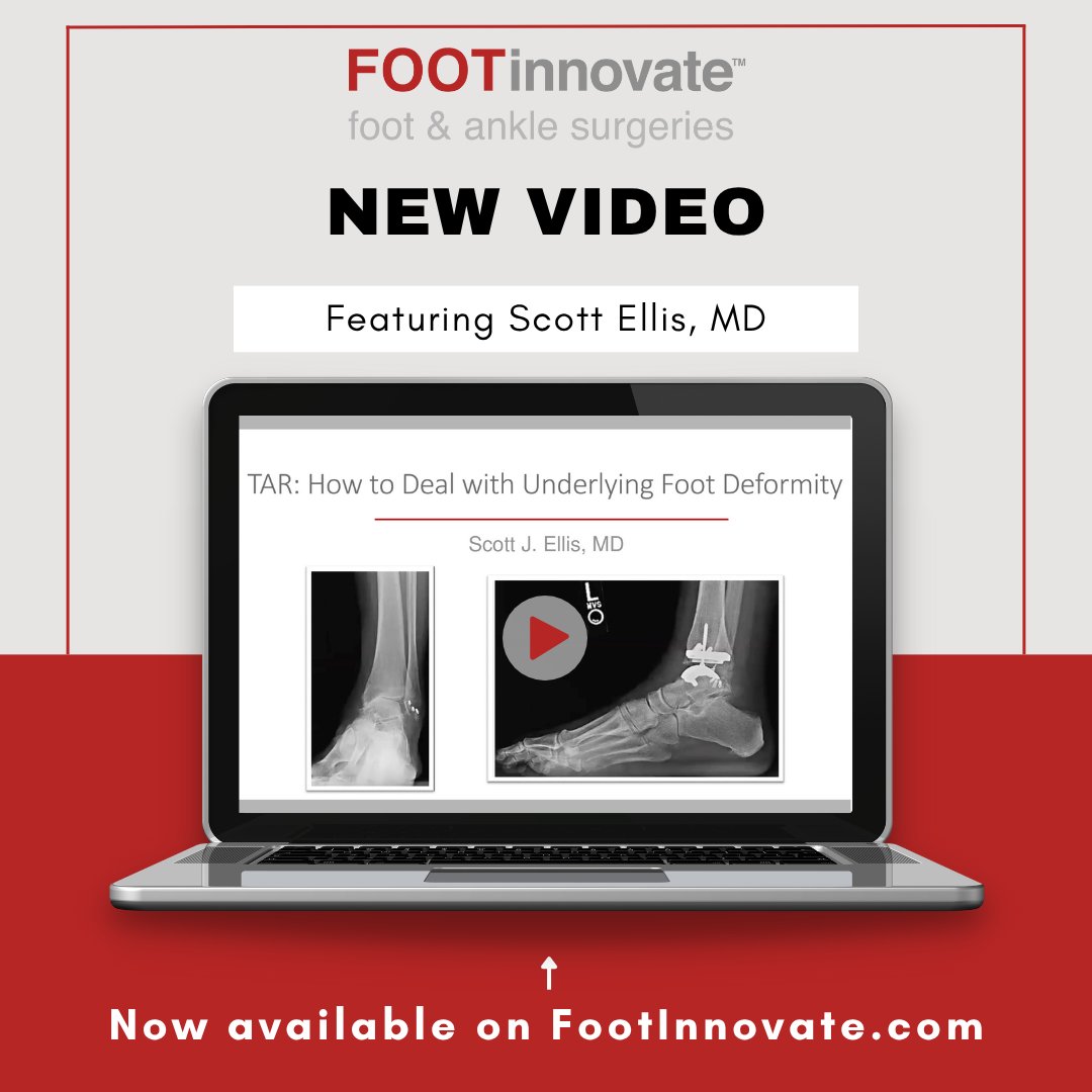 FootInnovate's tweet image. STREAM NOW: ow.ly/S9wq50Wf7j4
🔴⚪🔴JUST ADDED🔴⚪🔴

New Clinical Content: TAR: How to Deal with Underlying Foot Deformity with Scott Elllis, MD

 #TotalAnkleReplacement #FootDeformity #AnkleSurgery #OrthopedicSurgery #Podiatry