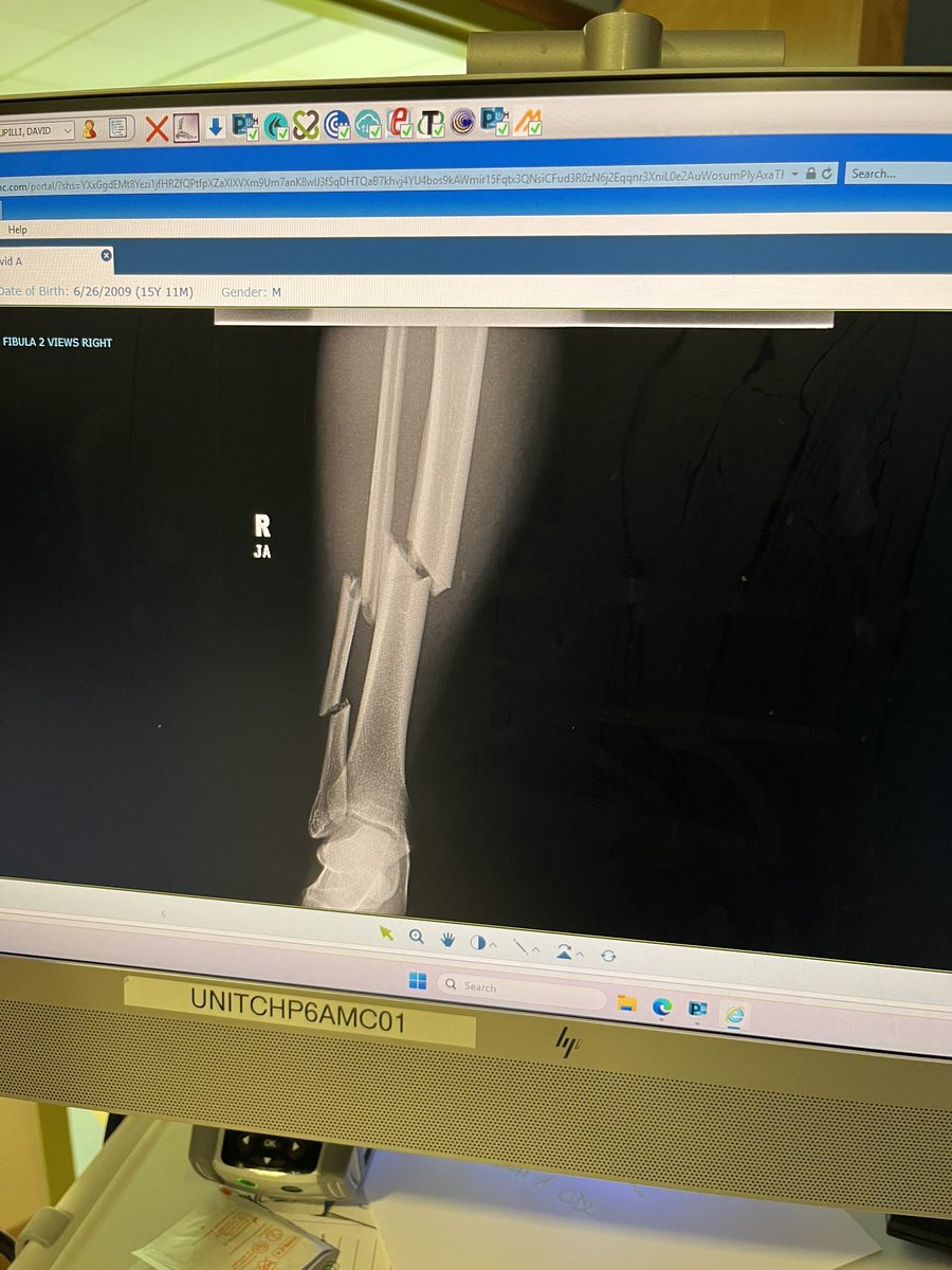 David_Pupilli's tweet image. Unfortunately fractured my Tibia and Fibula at Pitt 7on7 and I am out for the year. I under go surgery this Wednesday. Everything that happens is all gods doing and I can’t wait for where his path takes me. @PlumAthletics @pitt75panther @210ths @ajs909 @Coach_TJYoung @7Twice