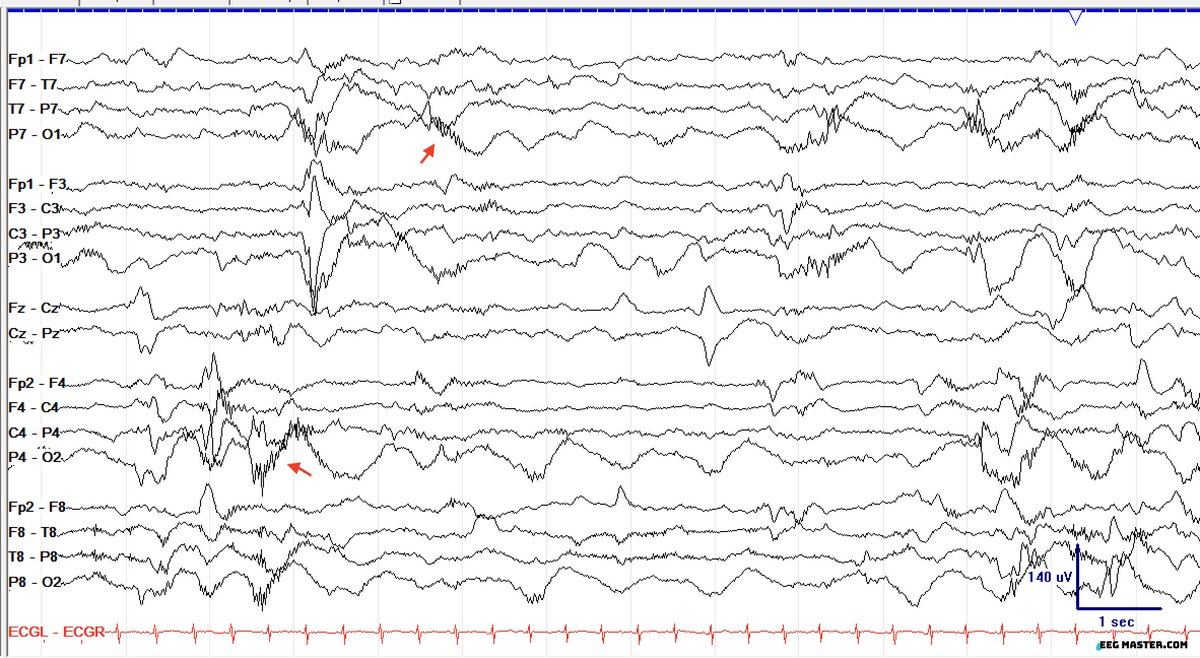 A 37-week-old newborn on therapeutic hypothermia for 12 hours to manage neonatal hypoxic-ischemic encephalopathy. Identify the finding signaled by the red arrows? Click on the link to submit your answer and view explanation. eegmaster.com/eegmaster/quiz…