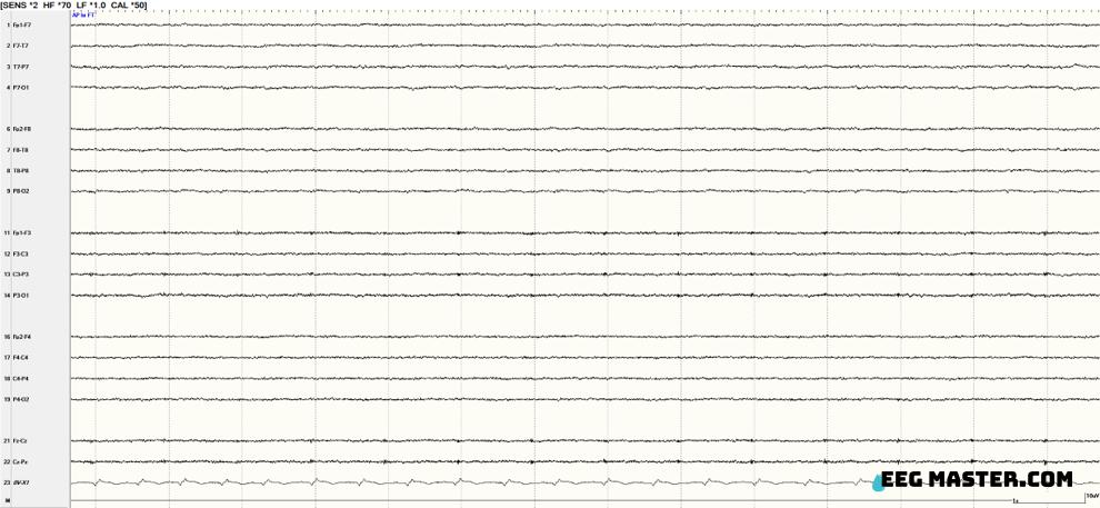 What is the EEG finding shown in the epoch below in a patient with no reaction to the stimulus? Click on the link to submit your answer and view explanation. eegmaster.com/eegmaster/quiz…