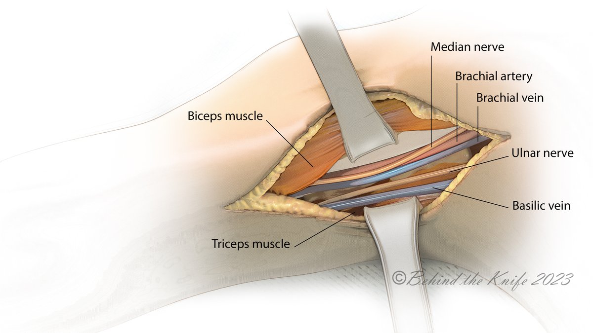 The brachial artery is the most commonly injured artery in the arm!  Fortunately, it's fairly easy to get to 👇🏼

1. Prep entire extremity &amp; consider prepping in tourniquet &amp; groin (for vein harvesting) 🧼🫧 
2. Make an incision in the groove between the bicep &amp; tricep muscles 🔪