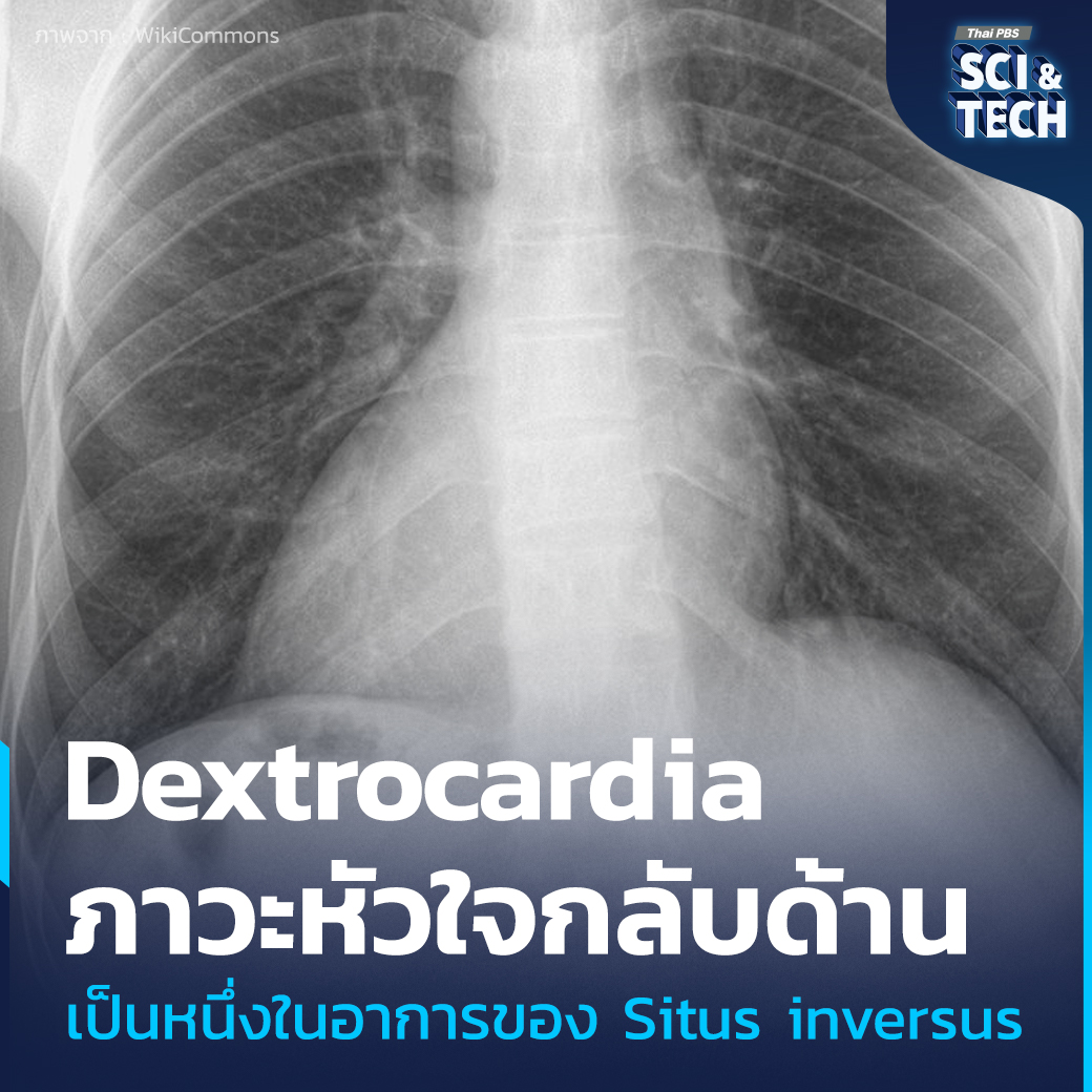 ThaiPBSSciTech's tweet photo. ภาวะ #อวัยวะภายในกลับด้าน รู้จัก Situs Inversus
#SitusInversus หรือ #ภาวะอวัยวะภายในกลับด้าน เป็นหนึ่งในภาวะความผิดปกติแต่กำเนิดที่หาได้ยาก อวัยวะภายในของร่างกาย เช่น หัวใจ ตับ ม้าม และกระเพาะอาหาร จะจัดวางในตำแหน่งตรงกันข้ามกับปกติอย่างสมบูรณ์หรือบางส่วน แม้ว่าโครงสร้างภายในจะสลับด้าน แต่การทำงานของอวัยวะกลับแทบไม่ต่างจากปกติ ทำให้คนส่วนใหญ่ที่มีภาวะนี้ไม่มีอาการใด ๆ และมักไม่รู้ตัวว่าตนเองมีภาวะนี้ จนกระทั่งเข้ารับการตรวจทางการแพทย์ด้วยเหตุผลอื่น ภาวะนี้พบได้เพียงประมาณ 1 ใน 10,000 คน เท่านั้น
📌อ่านต่อ : https://t.co/J2SJwOzwgX
--------------------------
🌏 “รอบรู้ ดูกระแส ก้าวทันโลก” ไปกับ #ThaiPBSSciAndTech #ThaiPBS