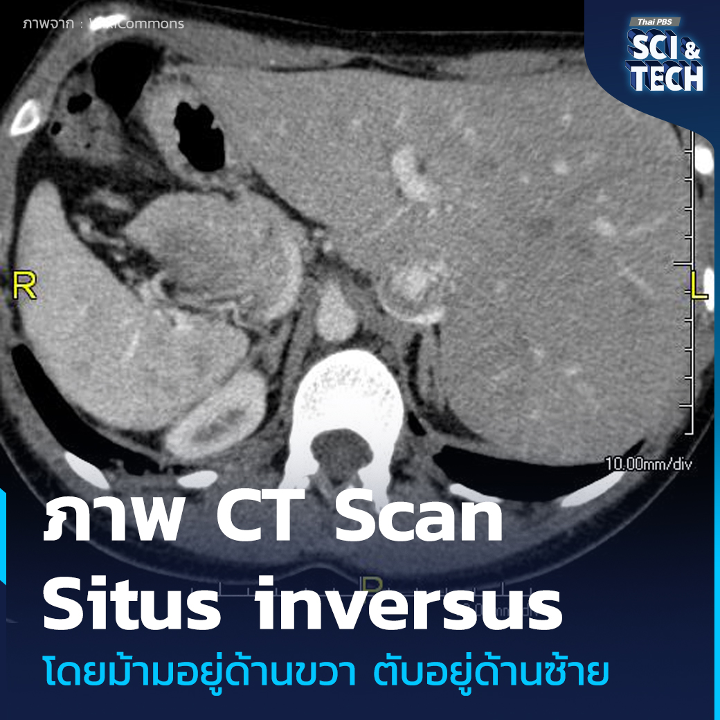 ThaiPBSSciTech's tweet photo. ภาวะ #อวัยวะภายในกลับด้าน รู้จัก Situs Inversus
#SitusInversus หรือ #ภาวะอวัยวะภายในกลับด้าน เป็นหนึ่งในภาวะความผิดปกติแต่กำเนิดที่หาได้ยาก อวัยวะภายในของร่างกาย เช่น หัวใจ ตับ ม้าม และกระเพาะอาหาร จะจัดวางในตำแหน่งตรงกันข้ามกับปกติอย่างสมบูรณ์หรือบางส่วน แม้ว่าโครงสร้างภายในจะสลับด้าน แต่การทำงานของอวัยวะกลับแทบไม่ต่างจากปกติ ทำให้คนส่วนใหญ่ที่มีภาวะนี้ไม่มีอาการใด ๆ และมักไม่รู้ตัวว่าตนเองมีภาวะนี้ จนกระทั่งเข้ารับการตรวจทางการแพทย์ด้วยเหตุผลอื่น ภาวะนี้พบได้เพียงประมาณ 1 ใน 10,000 คน เท่านั้น
📌อ่านต่อ : https://t.co/J2SJwOzwgX
--------------------------
🌏 “รอบรู้ ดูกระแส ก้าวทันโลก” ไปกับ #ThaiPBSSciAndTech #ThaiPBS