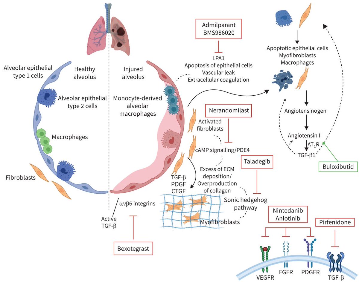 Breathe: Idiopathic pulmonary fibrosis and progressive pulmonary fibrosis are characterised by progressive fibrosis and share common pathophysiological pathways that have led to the study of promising new therapeutic targets. bit.ly/3RdJRqA