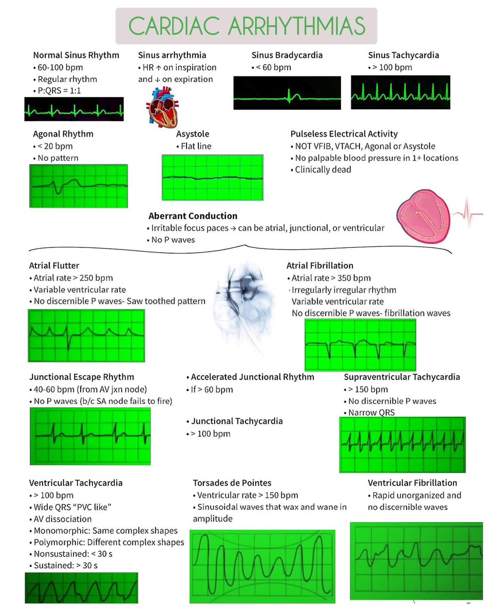 Cardiac Arrhythmias 😍