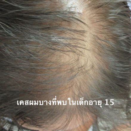 🚨ช่วงนี้เห็นน้องๆบ่นเรื่องผมร่วงกันเยอะนะ ละสังเกตุก็อายุยังน้อย เลยอยากมาแชร์🌲 เรื่องผมร่วงในผู้หญิง 💃ที่มีความสัมพันธ์กับช่วงอายุ

อย่างตอนสาว 💁🏻‍♀️จะมีอาการร่วงแบบนึง พอเริ่มแก่ไป 👩‍🦳ก็จะเพิ่มมาอีกแบบ ไรงี้ 
มาดูกันว่าพวกเรา ๆ นี่เข้าข่ายแบบไหนแล้วต้องทำไงบ้าง