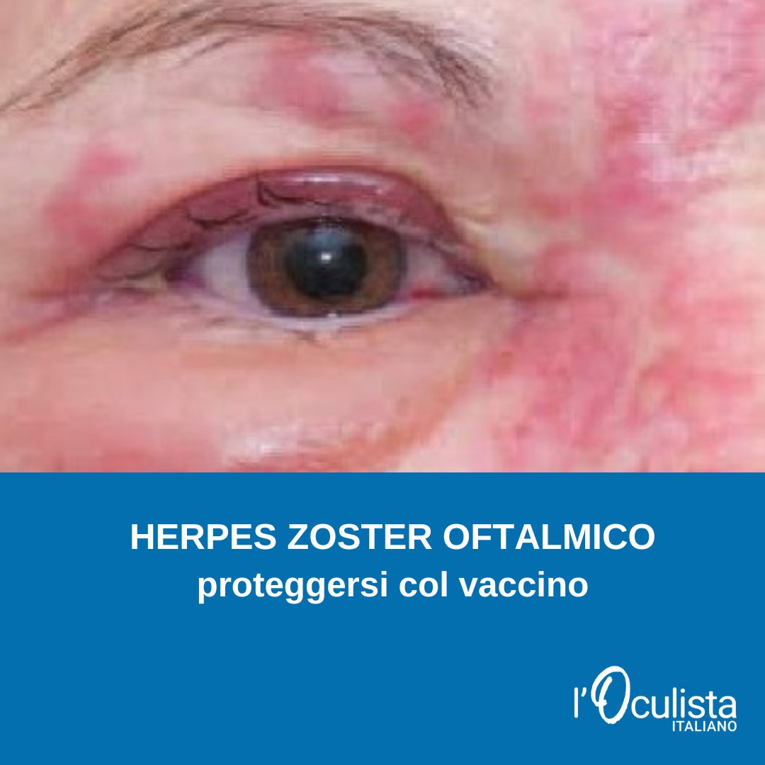 L’herpes zoster è un'infezione grave e dolorosa,  che si può prevenire  attraverso  un vaccino, basato sulla tecnologia del DNA ricombinante, che rappresenta un’opzione efficace e sicura in base ai dati di numerosi studi clinici. 
oculistaitaliano.it/articoli/herpe…