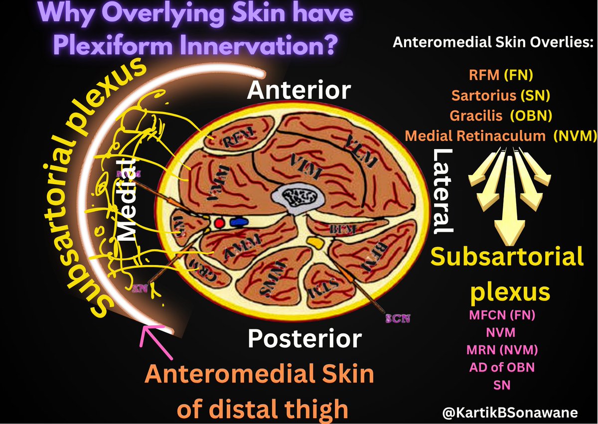 KartikBSonawane's tweet photo. 🧠 “A Nerve Never Wanders Alone -- It Follows Its Muscle to the End”
#RegionalAnesthesia #UltrasoundGuidedBlocks
#NervePlexusMatters #ThinkBeyondTheTrunk
#CutaneousBlockFallacy #ArticularInnervation
#TipOfTheDay #MyRATips
Tip of the Day:
A nerve is like a loyal companion,
Wherever its muscle travels, It walks beside.
🎯 Thought-Provoking Questions to Trigger Deeper Understanding
🔸Why does targeting a single nerve with limited volume often fail in achieving complete analgesia?
🔸Why is blocking just a cutaneous nerve often illogical in regional anesthesia?
🔸 Why should we care about plexuses formed under fascia and subcutaneous tissue?
🔸 Why is bony innervation often patchy and not predictable by dermatome maps?
🔸 Why do some patients still feel pain after a perfectly placed single-shot block?
🔁 General Rule: Muscle Determines the Nerve’s Fate
🦾 Muscle Body → Motor Branches
🦴 Muscle Insertion on Bone → Periosteal/Osteotomal Supply
🦿 Muscle Crossing Joint → Articular (genicular) Branches
🧤 Muscle Near Skin/Ending Superficially → Cutaneous Branches
🧩 ✨ Nerve Pathways and Examples
🔹 1. Obturator Nerve – A Story of Dual Division
🔸 Anterior Division
🚶♂️ Follows adductor longus and brevis (superficial muscles)
🧤 When these end at linea aspera, the nerve becomes cutaneous
🤝 Joins subsartorial plexus to supply medial thigh skin
🔸 Posterior Division
🚇 Travels with adductor magnus (deep muscle)
🚪 Passes through adductor hiatus
⚙️ Contributes to popliteal plexus and genicular supply
🦴 Sends branches to femoral condyle, following the muscle’s bony insertion
🔹 2. Saphenous Nerve – A Sensory Nerve with a Hidden Motor Gift
🌱 Terminal branch of posterior division of femoral nerve, classically sensory
🦿 In adductor canal:
🦾 Gives motor twig to sartorius
⚠️ Making it a mixed nerve in its early course
🧵 Exits canal via vastoadductor membrane, turns purely sensory
🧤 Supplies:
Infrapatellar region (via infrapatellar branch)
Medial leg and ankle (along great saphenous vein)
Sometimes periosteum of tibia and medial knee joint capsule
🔹3. Radial Nerve – The Master of Posterior Compartment
🦾 Supplies triceps → once muscle ends at olecranon,
🦴 Gives periosteal twigs to elbow
🔩 Sends articular branches to posterior elbow capsule
🪓 After crossing lateral intermuscular septum,
✂️ Divides into superficial branch (sensory) and posterior interosseous (motor)
🧤 Superficial branch becomes cutaneous nerve of dorsum of hand
🔹 4. Tibial Nerve – Through Soleus to Sole
🦿Travels with gastrocnemius, soleus, and tibialis posterior
🦴 Sends periosteal branches to posterior tibia and ankle
🔩 Gives articular twigs to ankle and knee joint capsules
🧤 Ends as medial and lateral plantar nerves
Supplies intrinsic foot muscles
Becomes cutaneous over sole of foot
💡 Clinical Pearls to Remember
⚠️ Cutaneous branches often emerge only after motor duty is over
💉 In nerve blocks, knowing this principle helps predict:
✔️ Muscle weakness
✔️ Periosteal pain
✔️ Joint coverage
✔️ Skin anesthesia
🧬 Dermatomes, myotomes, and osteotomes often overlap → Because they stem from the same nerve-muscle-bone journey
“Where the muscle leads, the nerve proceeds -
Giving strength, then sensation, then articular deeds.
From motor roots to skin so fine,
The nerve follows faithfully, line by line.”