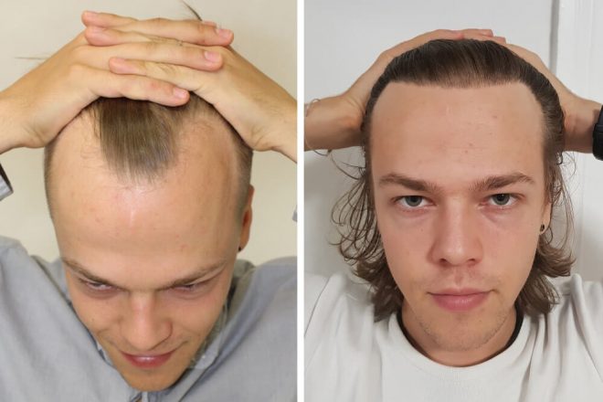 pokies_au's tweet photo. https://t.co/cQnr39ObyI Vous souhaitez retrouver votre ligne de cheveux juvénile ? 🌟 Optez pour une greffe de cheveux FUE dans notre clinique de Budapest ! Dites adieu aux lignes de cheveux dégarnies, aux cheveux fins et aux zones dégarnies. #GreffeDeCheveux #greffecheveux https://t.co/qtMbuqbgFj